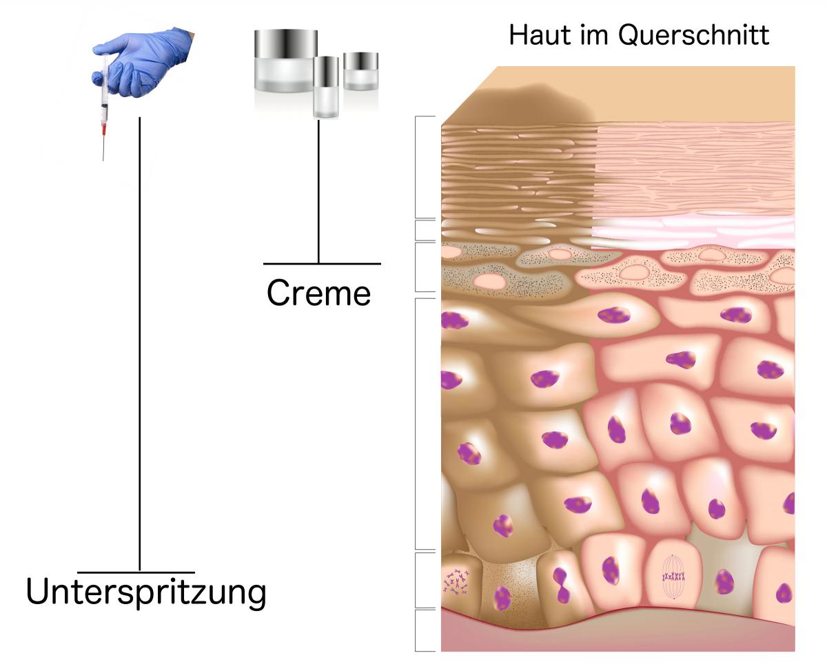 hyaluronsaeure-creme-unterspritzung-vergleich
